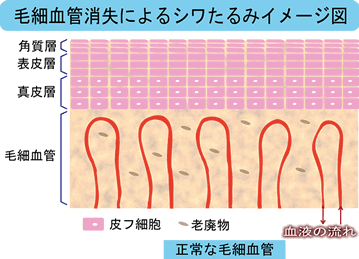 毛細血管消失によるシワたるみ