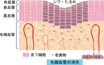 毛細血管の消失によるゴースト血管